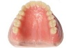 Full Denture(Vnbreakale Resin) with Heraeus acryli