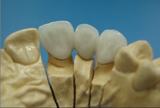 dental porcelain fused to metal crown