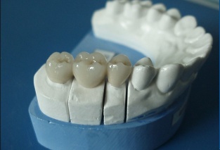 dental porcelain fused to metal crown