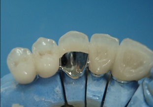 dental porcelain fused to metal crown